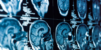 Study: Alcohol Causes More Damage to Brain than Marijuana shutterstock 107572736