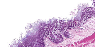 Why Clean Cannabis Matters Severe bacterial (shigella, salmonella, cholera) infection of the intestines resulting in enteritis with ulcers of the intestinal mucosal lining and bacterial colonies adherent to the dead tissue.